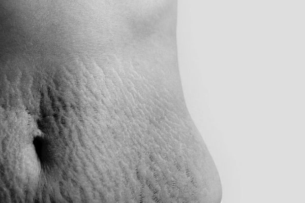 Body After Baby